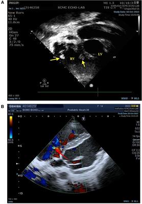 Libman-Sacks endocarditis in a child with systemic lupus erythematosus: a case report and literature review